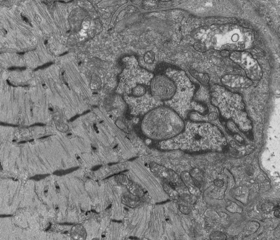 Transmission electron microscopy used to visualize a deformed nucleus and disorganized sarcomeres.