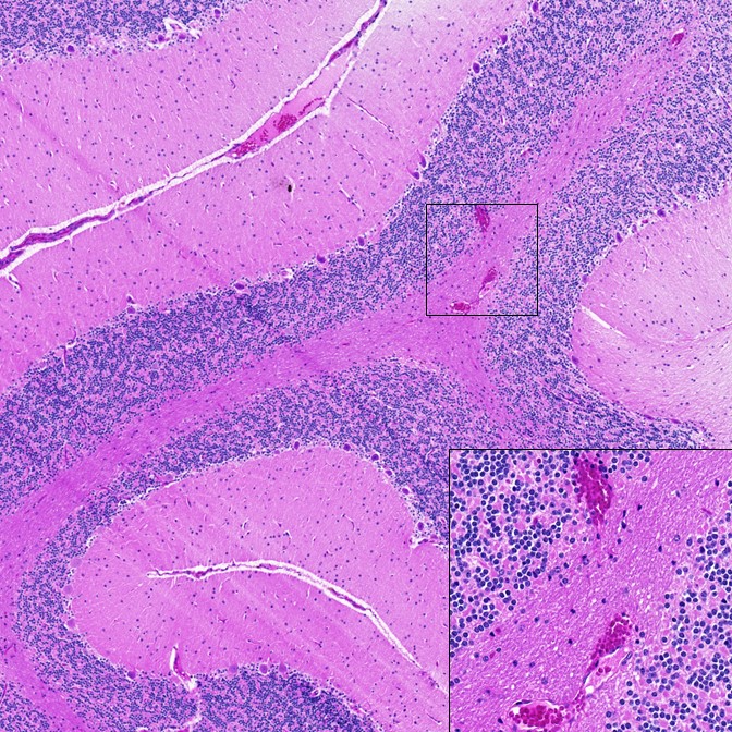 An increase in the number of brain microhemorrhages is observed with SARS-CoV-2 infection, as depicted here in cerebellum from an infected African green monkey.