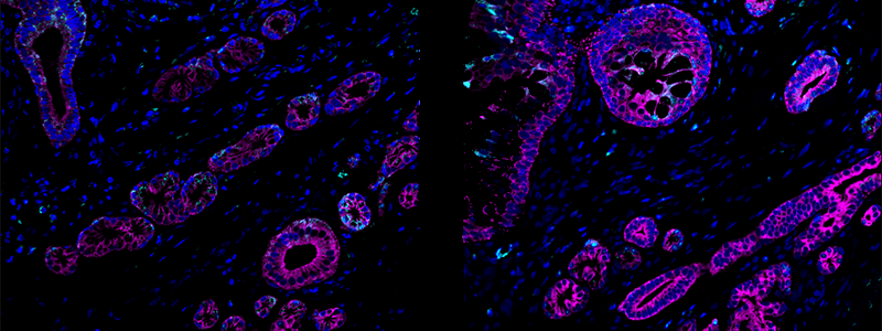 Immunohistochemical localization of SARS-CoV-2 nucleoprotein (NP) in nasal tissue of a rhesus macaque 3 days after infection. Immunofluorescent staining for SARS-CoV-2 NP is shown in teal within the cytoplasm of nasal epithelial cells, and submucosal glands are shown in magenta. NP is sporadically present in cells in the stroma of the submucosa. All cell nuclei are stained blue. Image courtesy of Dr. Dhiraj Kumar Singh, SNPRC.