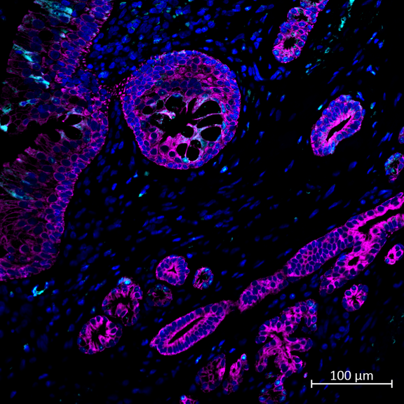 Immunohistochemical localization of SARS-CoV-2 nucleoprotein (NP) in nasal tissue of a rhesus macaque 3 days after infection. Immunofluorescent staining for SARS-CoV-2 NP is shown in teal within the cytoplasm of nasal epithelial cells, and submucosal glands are shown in magenta. NP is sporadically present in cells in the stroma of the submucosa. All cell nuclei are stained blue. Image courtesy of Dr. Dhiraj Kumar Singh, SNPRC.