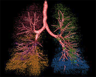 High-resolution image of abnormal air retention in the lobes of the human lung after the development of emphysema.