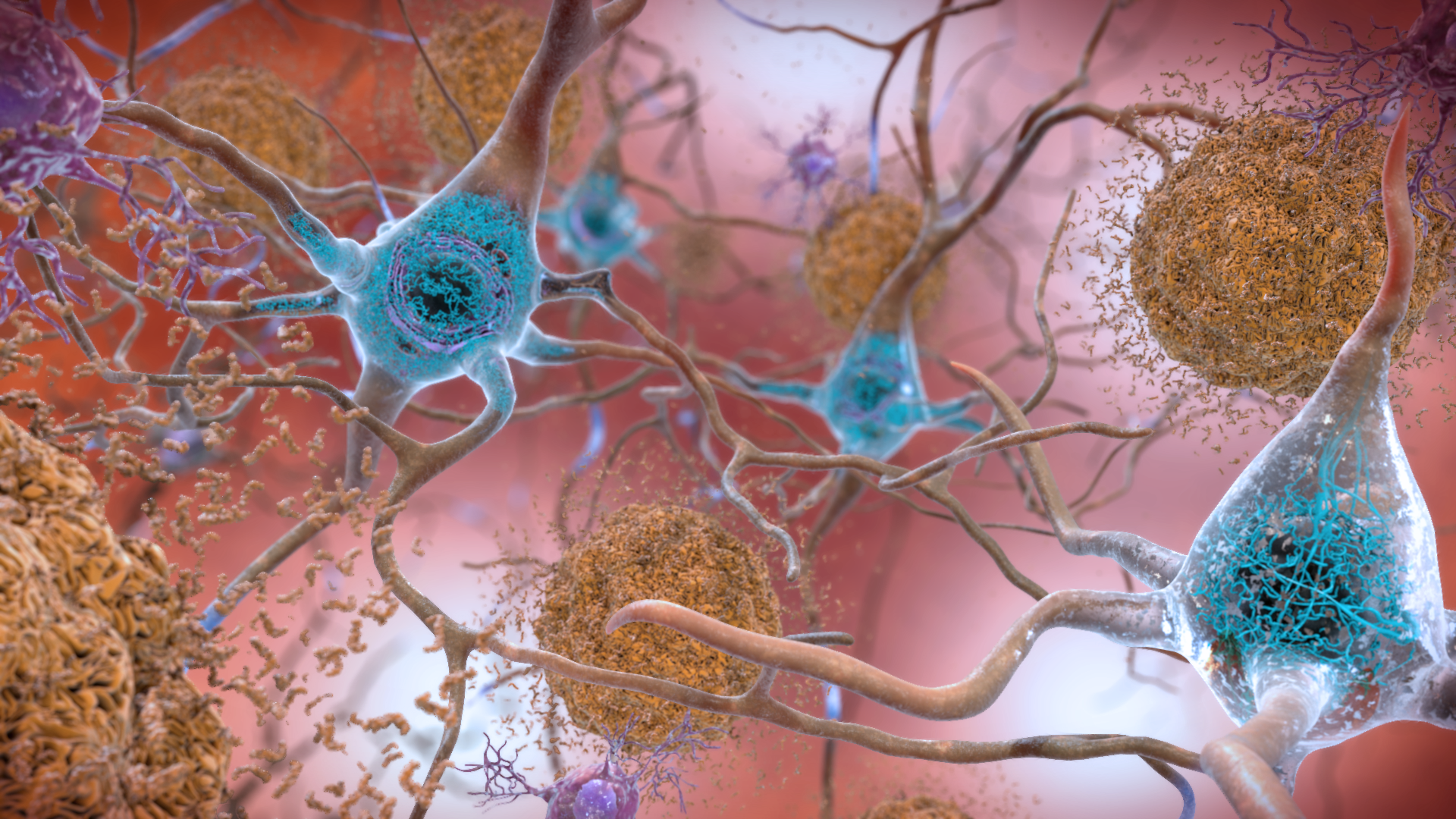 Beta-amyloid plaques and tau in the brain. 