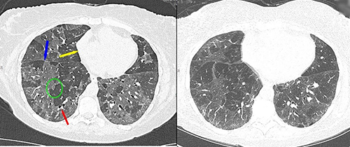 The PCD-CT image demonstrates increased spatial resolution, with more clearly visible small bronchioles compared with energy integrating detector CT.