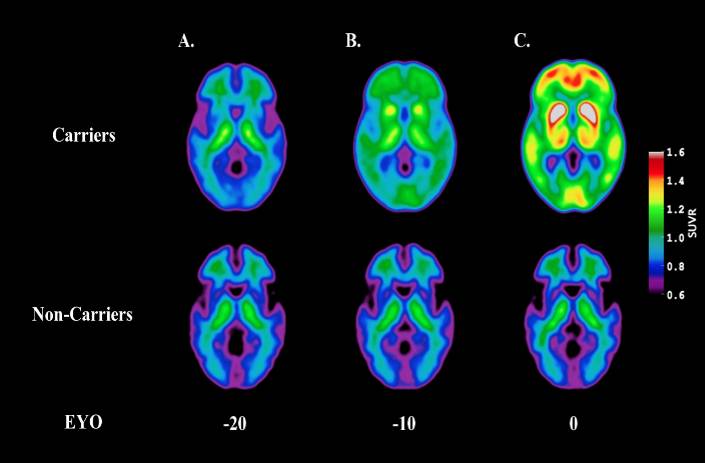 Amyloid deposition in the brain