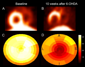 Positron emission tomography.