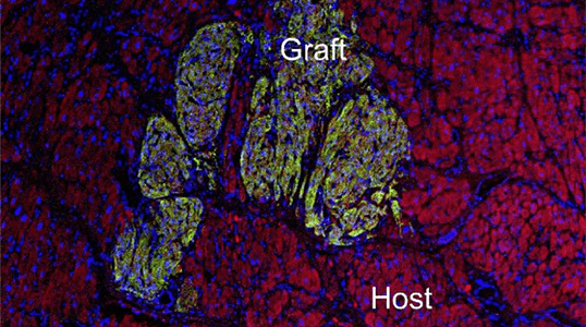 A graft of human stem cell–derived heart cells is integrated into the host cardiac muscle.