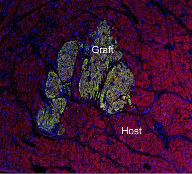 A graft of human stem cell–derived heart cells is integrated into the host cardiac muscle.